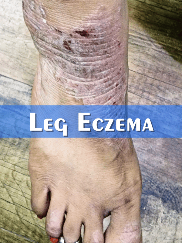 Leg Eczema Treatment